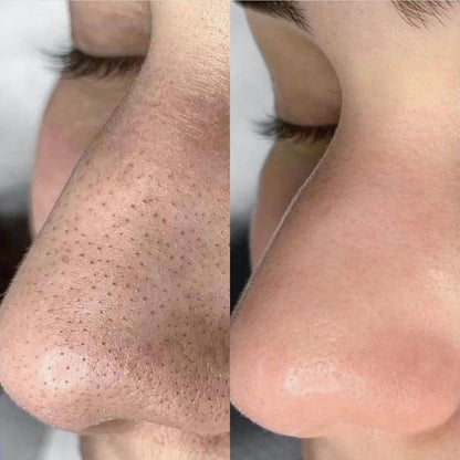 SkinClear™ — Deep Pore Cleansing Device