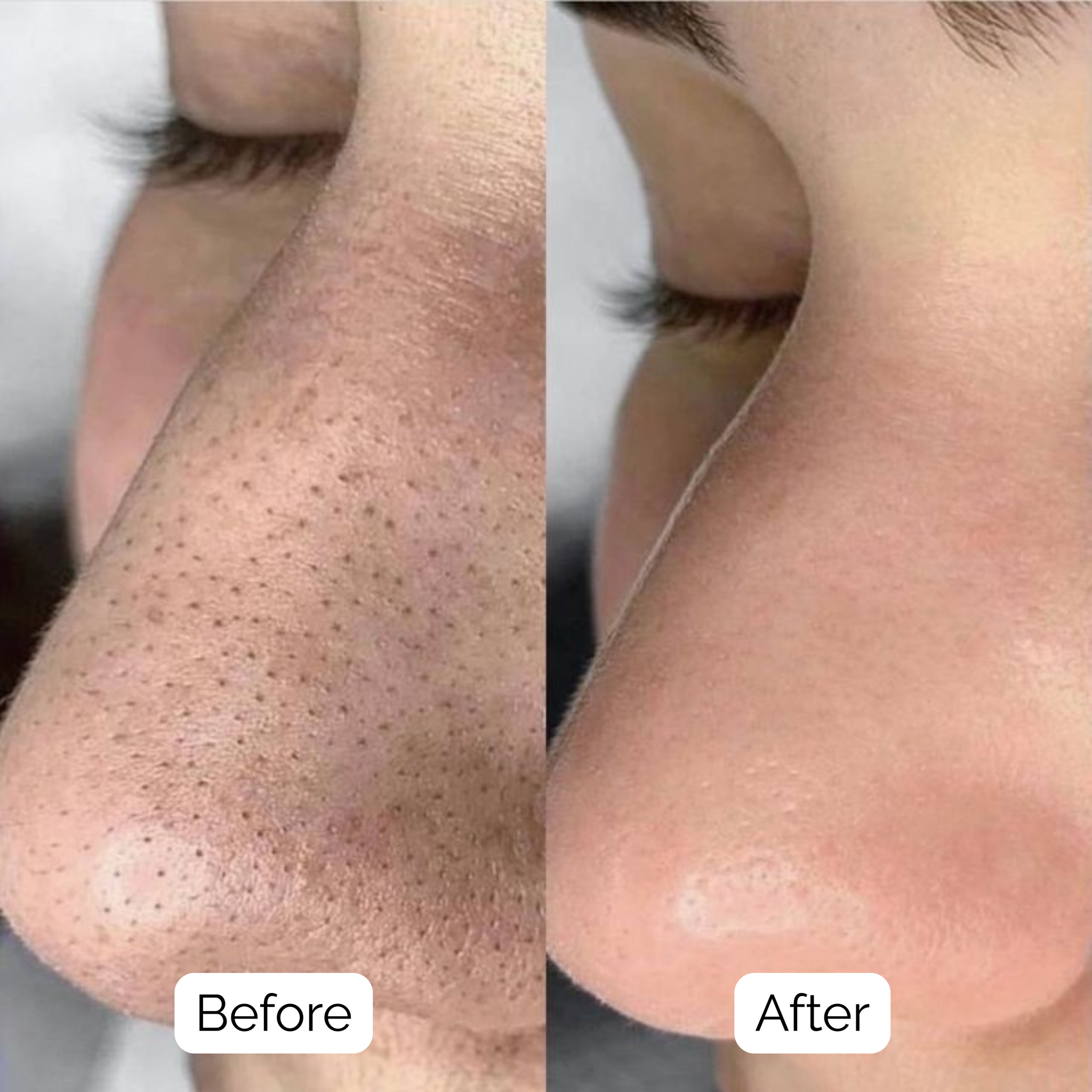 SkinClear™ — Deep Pore Cleansing Device