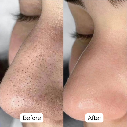 SkinClear™ — Deep Pore Cleansing Device