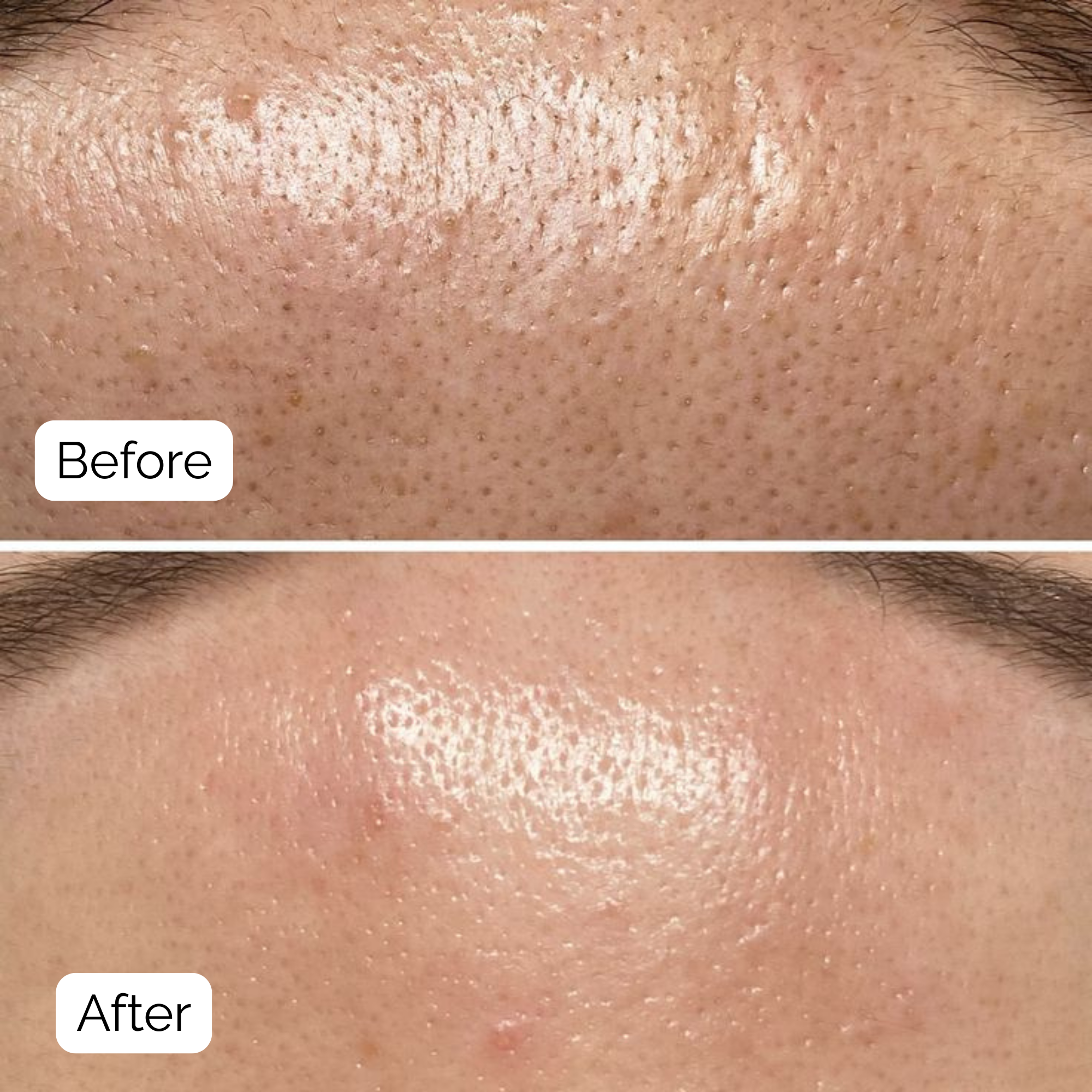 SkinClear™ — Deep Pore Cleansing Device